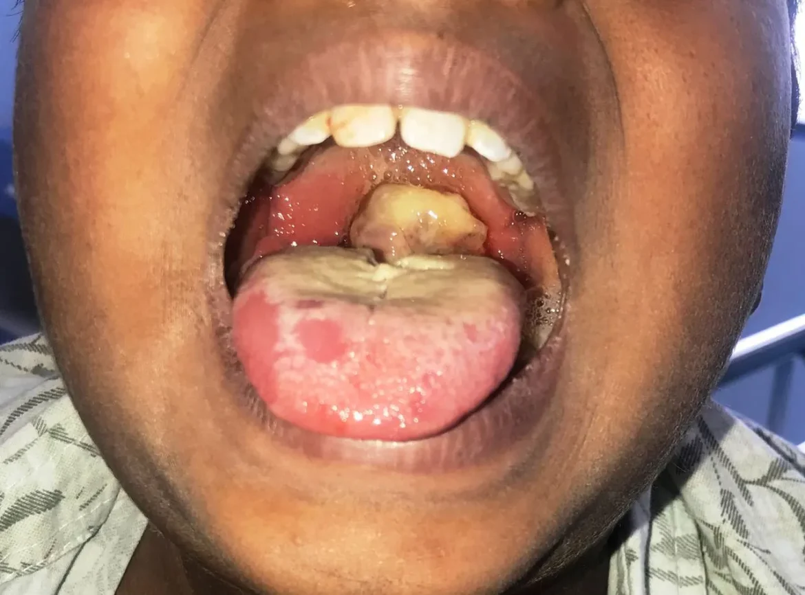 Suspected Diphtheria Outbreak Kills 3 Children in Zaria